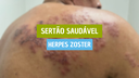 Sertão Saudável Herpes Zoster